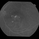 CSCR subfoveal leak