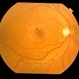 Perifoveal telangiectasia