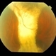 exudative AMD