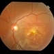 Heredomacular Degeneration
