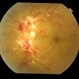 Hypertensive Retinopathy