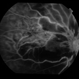 Ischaemic CRVO