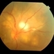 blastomycosis