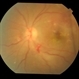 endogenous endophthalmitis following meningitis