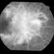 Dengue Retinitis
