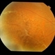 Juvenile Retinoschisis