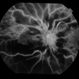 Ischaemic CRVO