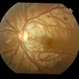 Traumatic Optic Neuropathy