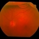 spontaneous submacular hemorrhage