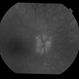 Papilledema