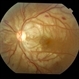 Traumatic Optic Neuropathy