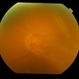 Globe perforation with periocular anaesthesia needle
