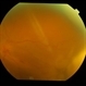Globe perforation with periocular anaesthesia needle
