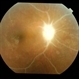 Behcet's Disease