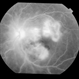 Dengue Retinitis