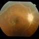 Behcet's Disease