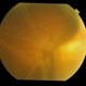 Globe perforation with periocular anaesthesia needle