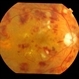 Ischaemic  Diabetic Maculopathy