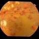 Ischaemic diabetic maculopathy