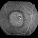 Heredomacular Degeneration