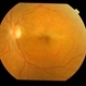Dengue retinitis