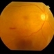 Neovascularisation Disc