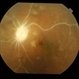 Behcet's Disease