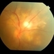 blastomycosis