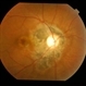 Traumatic Optic Neuropathy