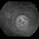 Heredomacular Degeneration