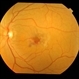 Perifoveal Telangiectasia with CNVM