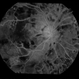 Ischaemic diabetic maculopathy