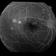 Central Serous Chorioretinopathy