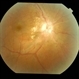 Hypertensive Retinopathy