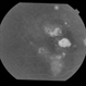 Central Serous Chorioretinopathy