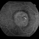 Heredomacular Degeneration