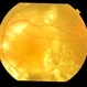 Exudative AMD