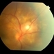 blastomycosis