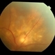 blastomycosis
