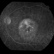 Heredomacular Degeneration