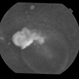 Central Serous Chorioretinopathy