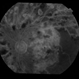 Ischaemic diabetic maculopathy