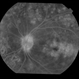 Cystoid Macular Edema