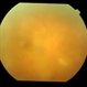 Dengue Retinitis
