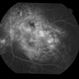 chronic central serous chorioretinopathy