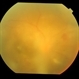 Dengue Retinitis