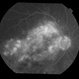 chronic central serous chorioretinopathy