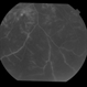chronic central serous chorioretinopathy