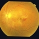 Dengue Retinitis