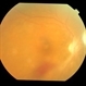 Dengue Retinitis